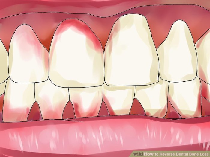 Reverse Dental Bone Loss