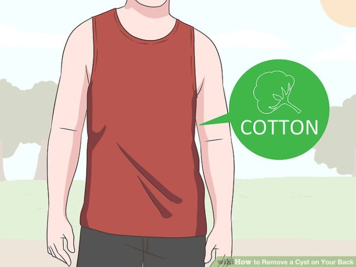 Skin Cyst On Back Remove a Cyst on Your Back
